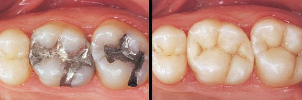 Tooth Coloured fillings 3